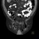 Lung tumour, bone metastasis in pubic bone, inguinal hernia: CT - Computed tomography